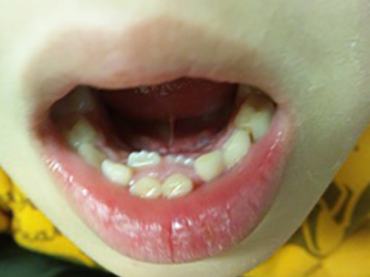七歳の息子の下の歯の生え変わり